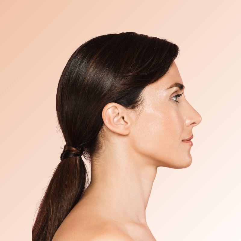 Non-Surgical Rhinoplasty Before and After in Miami