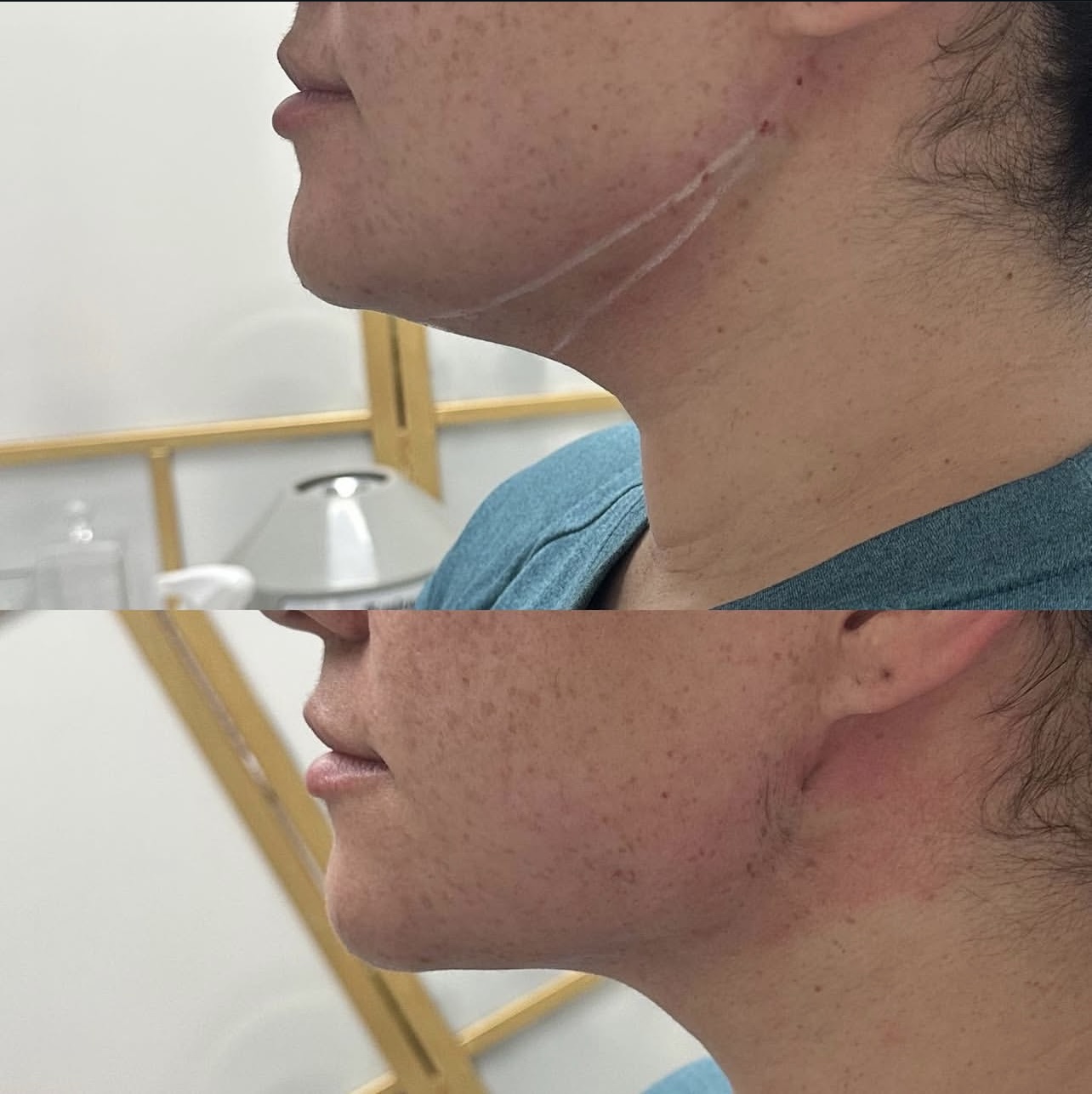 kybella Patient 2