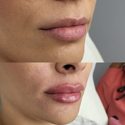 lip-augmentation Patient 3