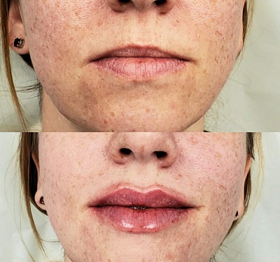 lip-augmentation Patient 2