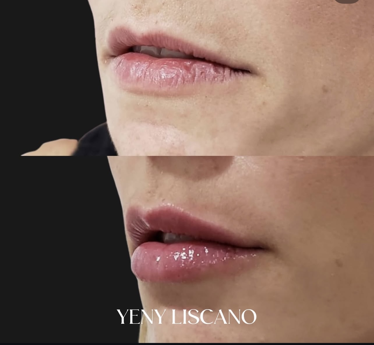 lip-augmentation Patient 20