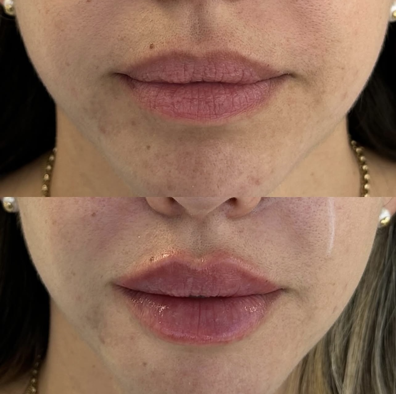 lip-augmentation Patient 19