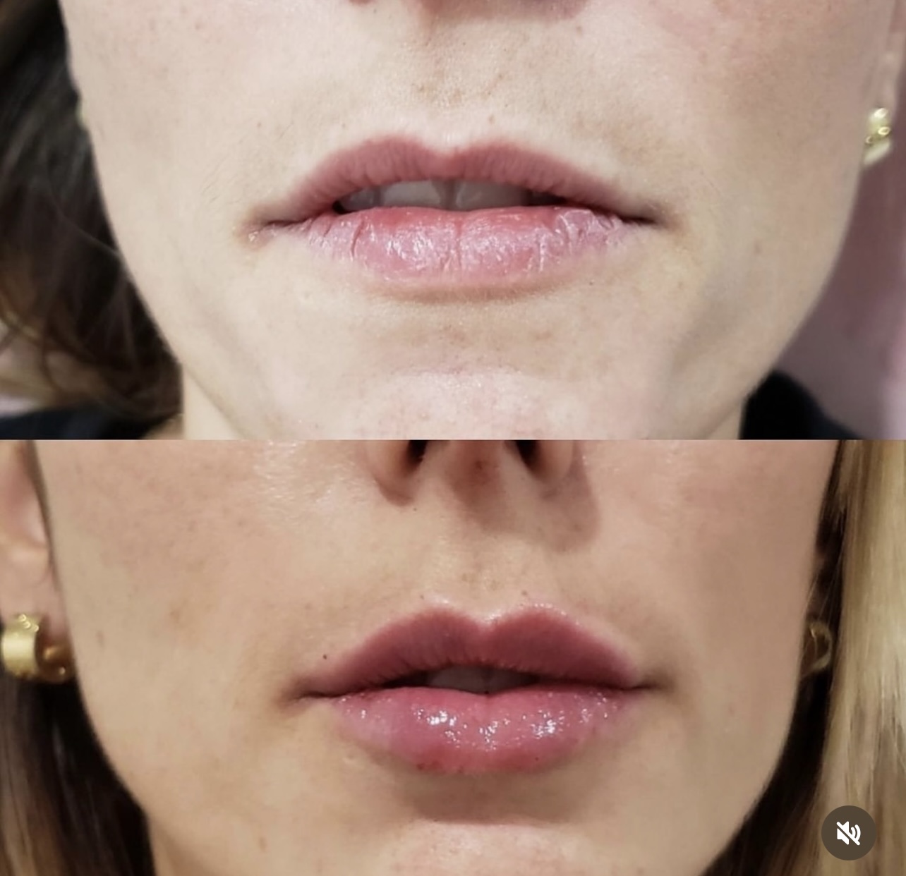 lip-augmentation Patient 18