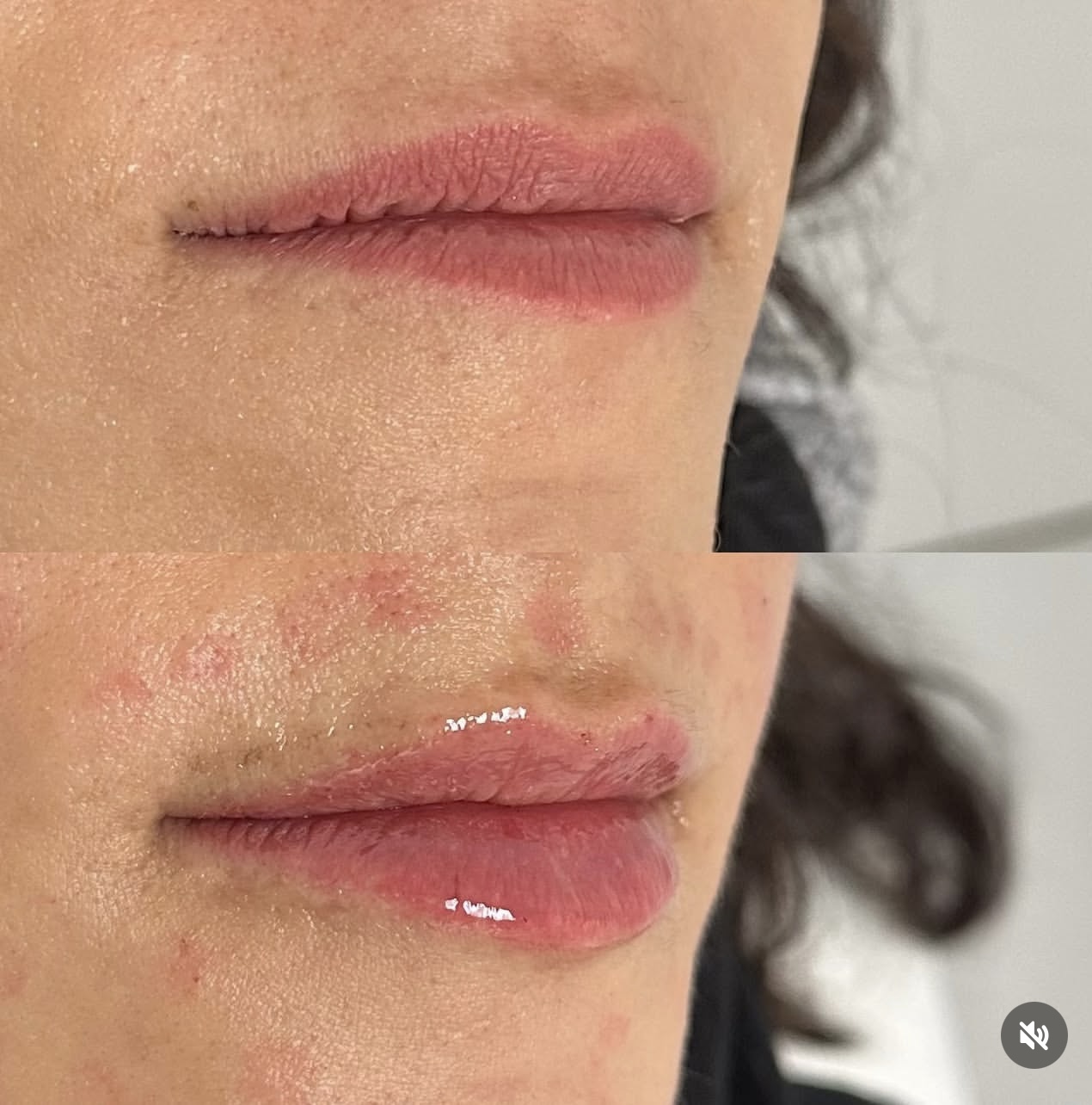 lip-augmentation Patient 17