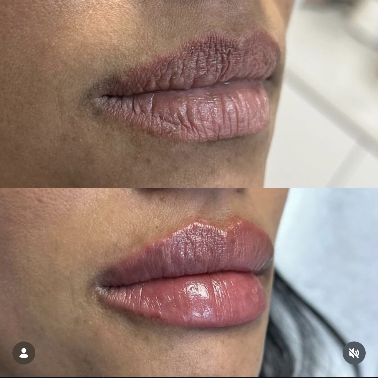 lip-augmentation Patient 16