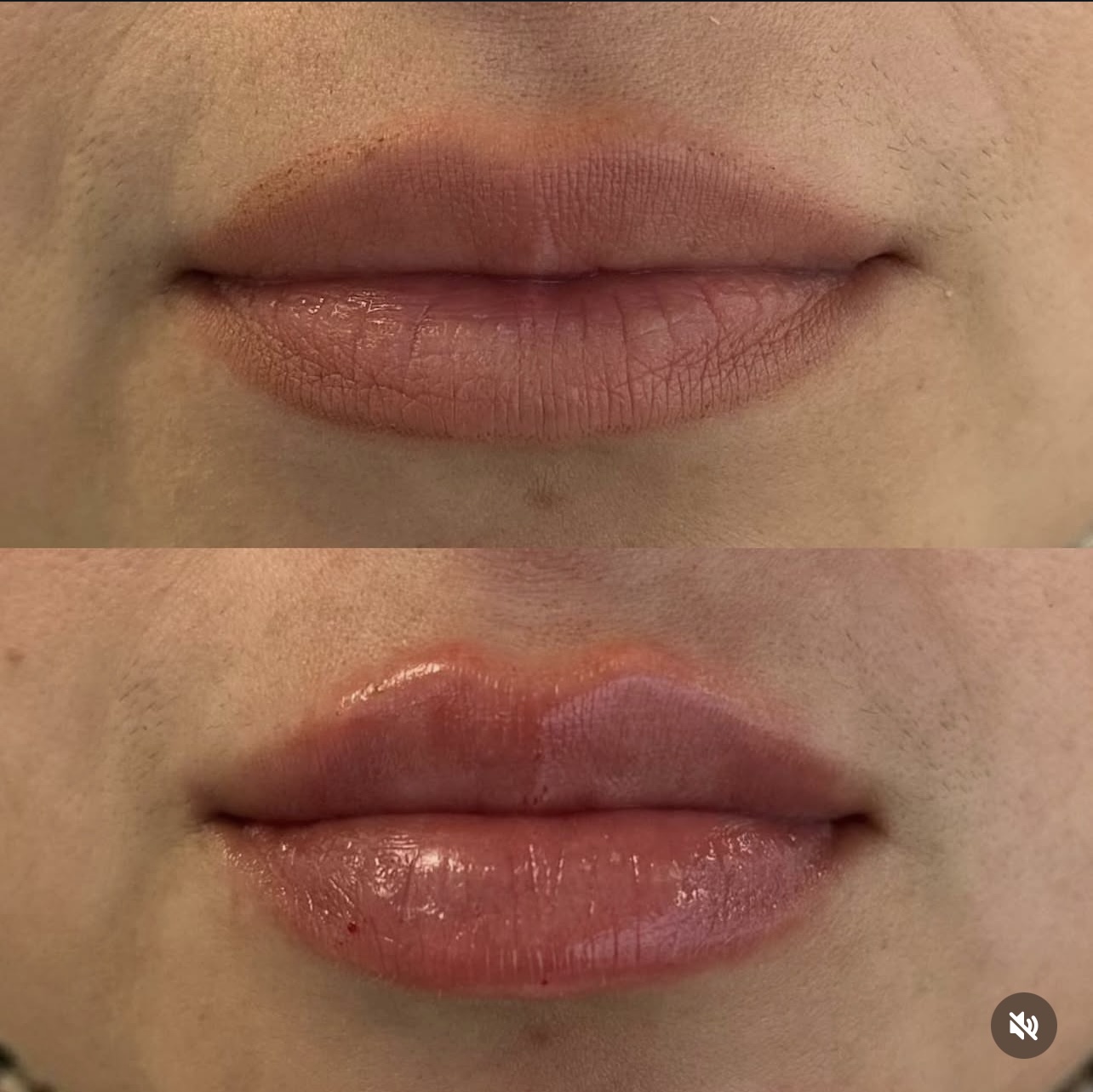 lip-augmentation Patient 15