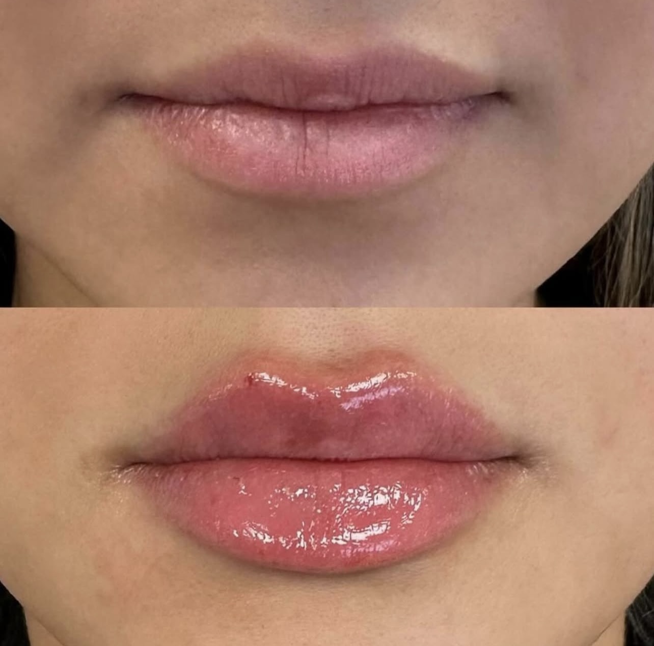 lip-augmentation Patient 14
