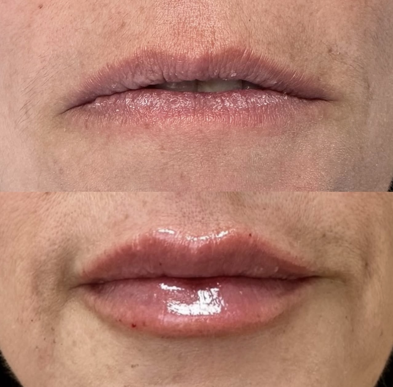 lip-augmentation Patient 13