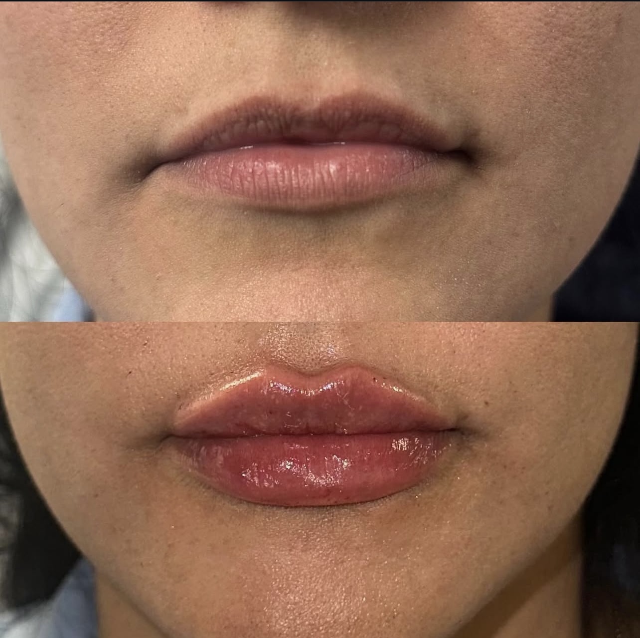 lip-augmentation Patient 12
