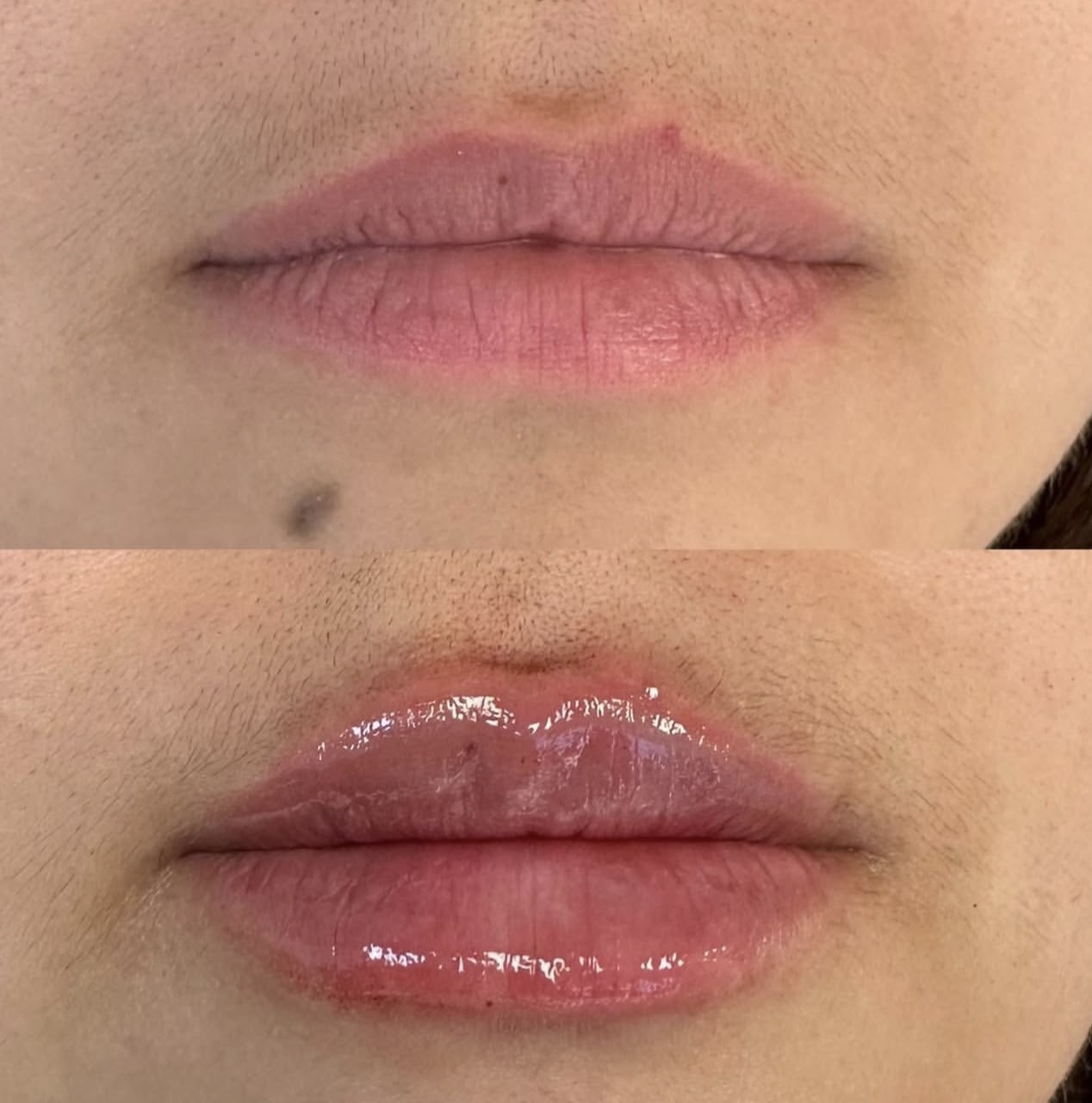 lip-augmentation Patient 11