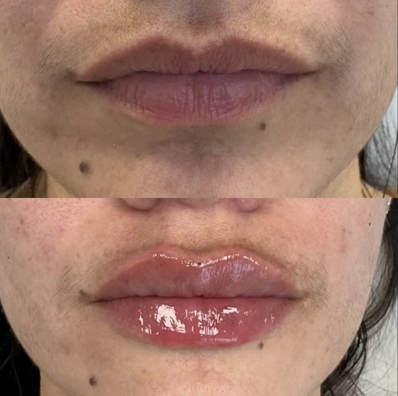 lip-augmentation Patient 10
