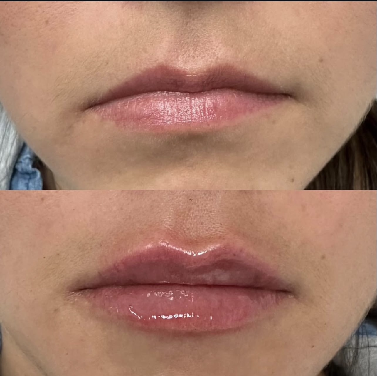 lip-augmentation Patient 9