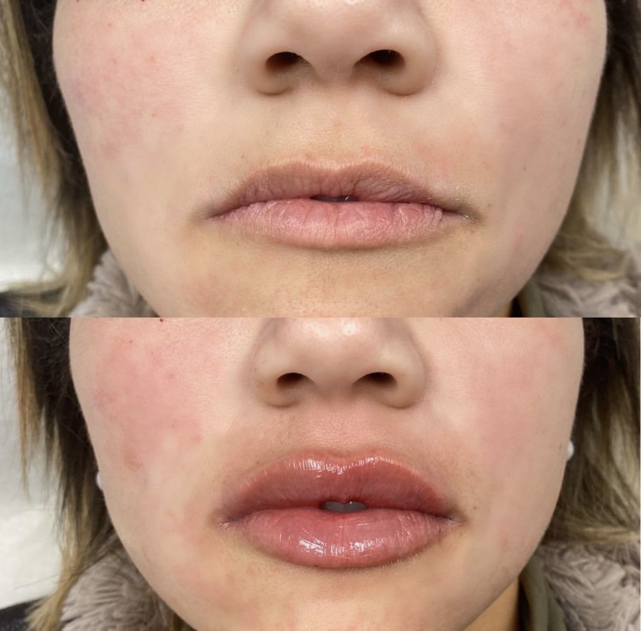 lip-augmentation Patient 8