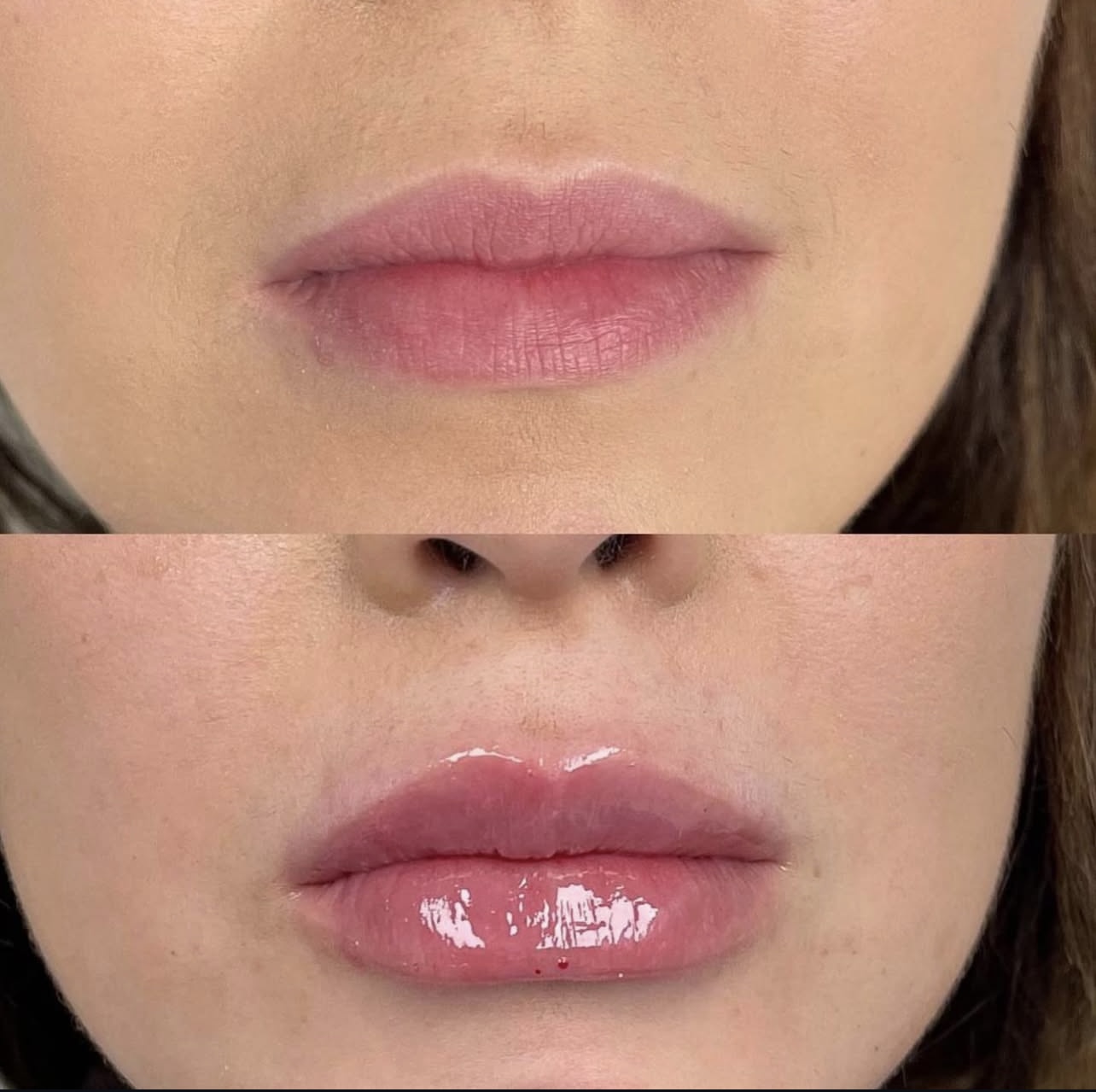 lip-augmentation Patient 7