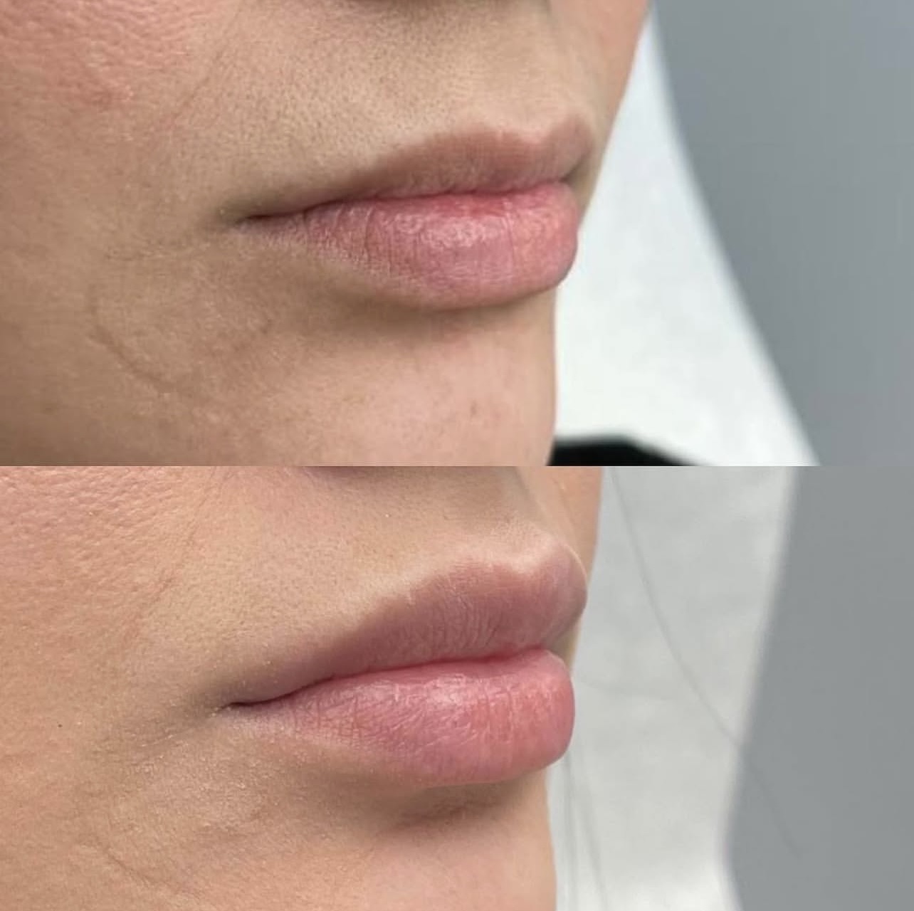 lip-augmentation Patient 6