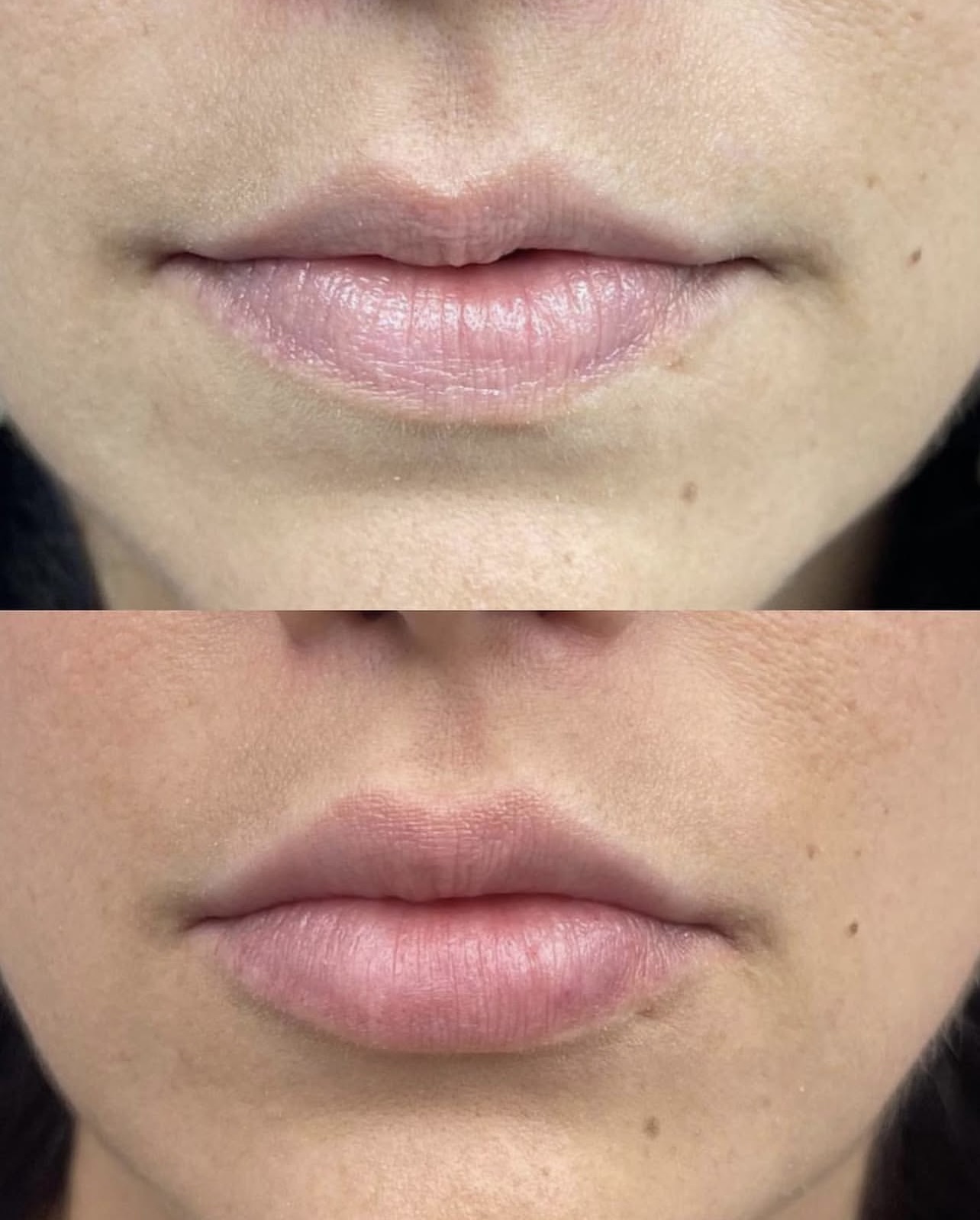 lip-augmentation Patient 5