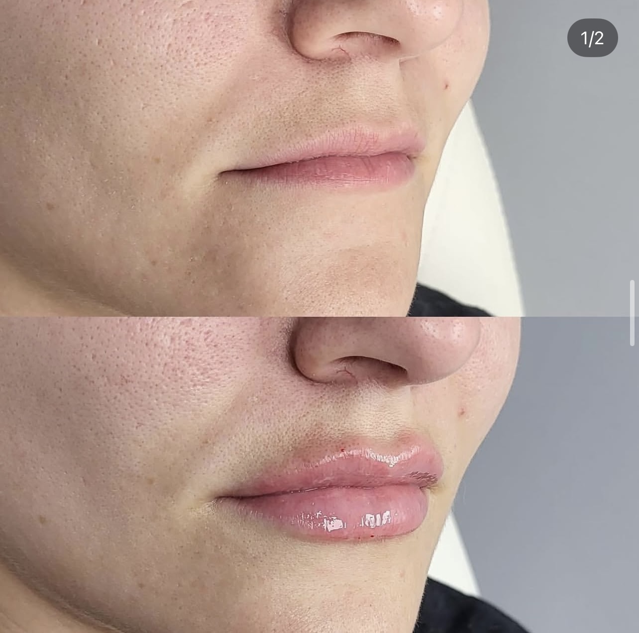 lip-augmentation Patient 4
