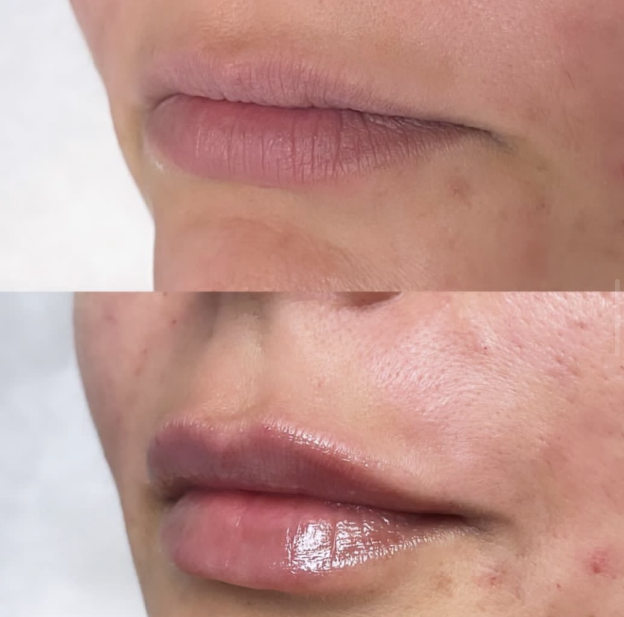 lip-augmentation Patient 3