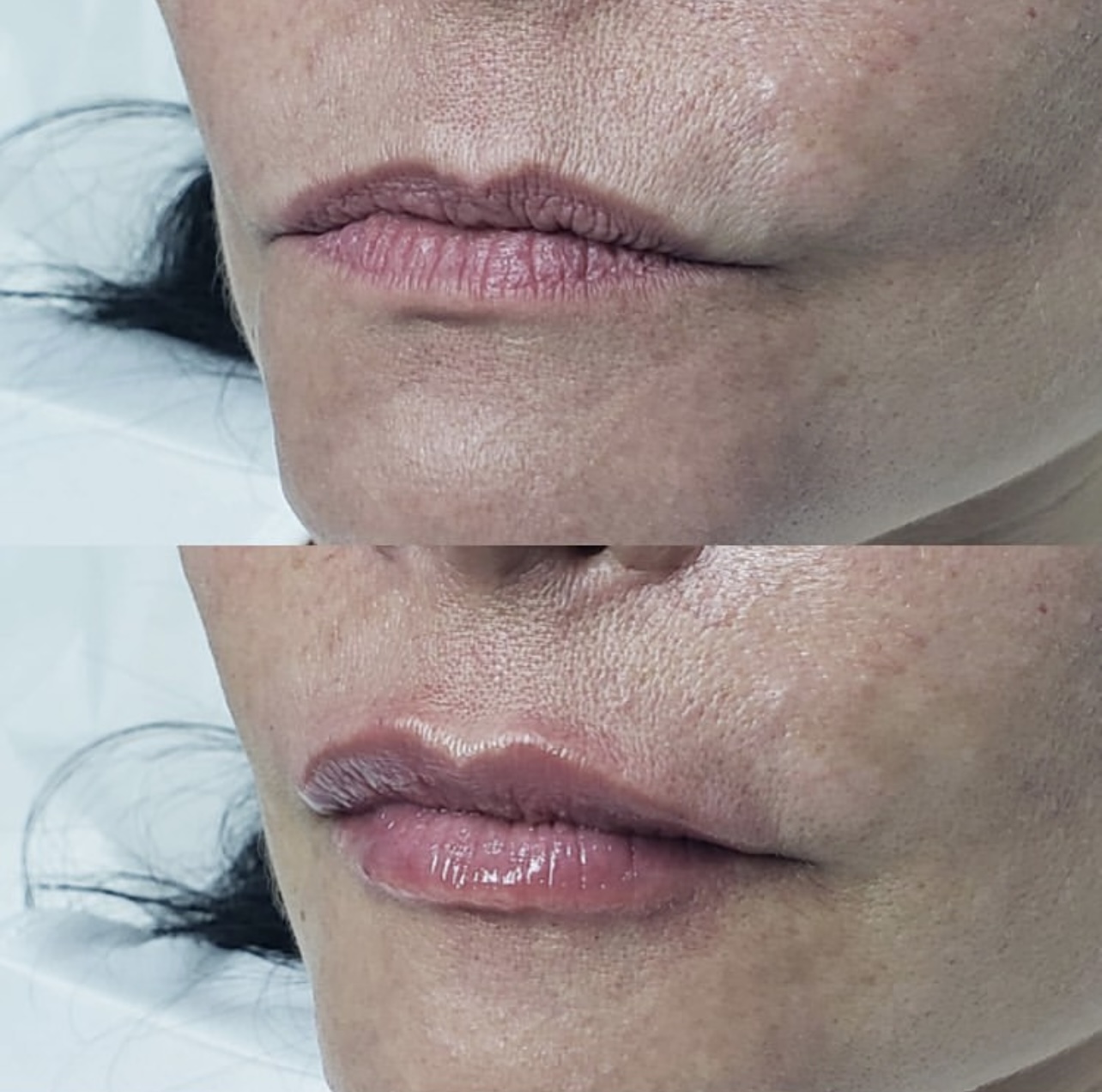 lip-augmentation Patient 2