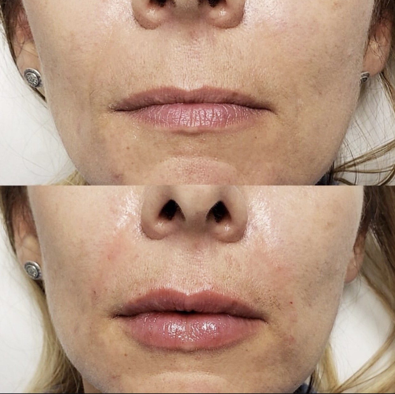 lip-augmentation Patient 1
