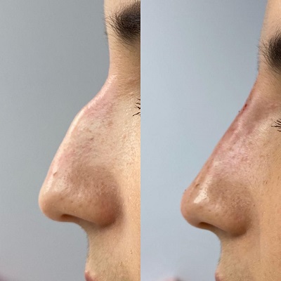 rhinoplasty Patient 4