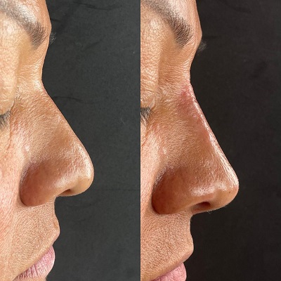 rhinoplasty Patient 3