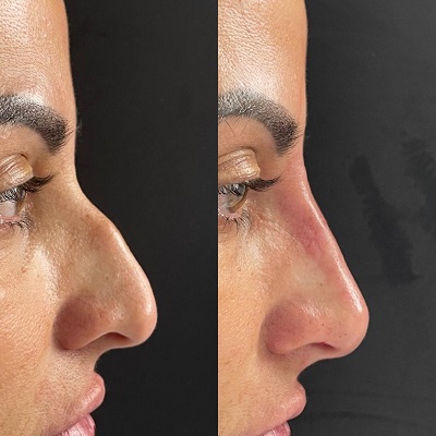rhinoplasty Patient 2