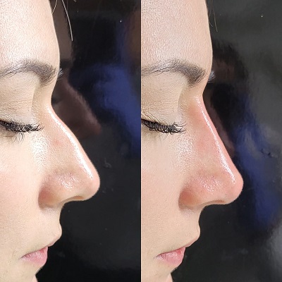 rhinoplasty Patient 1