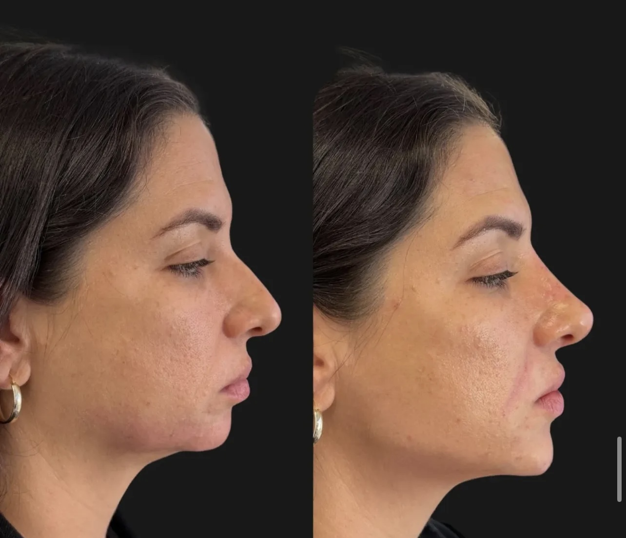 rhinoplasty Patient 17