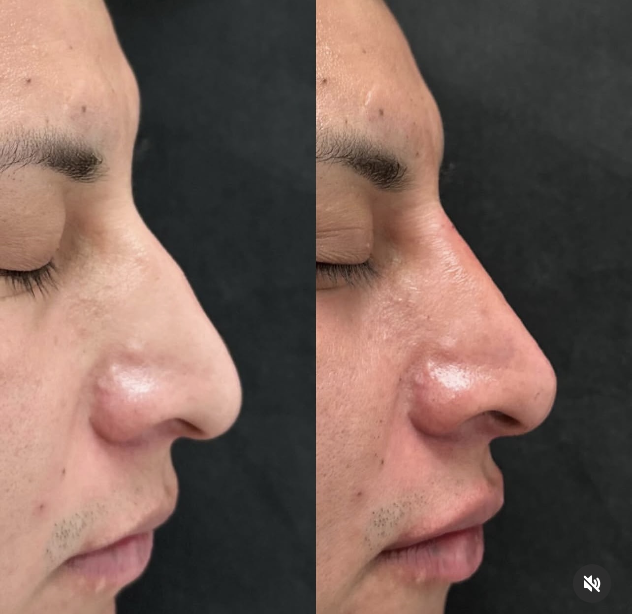 rhinoplasty Patient 14