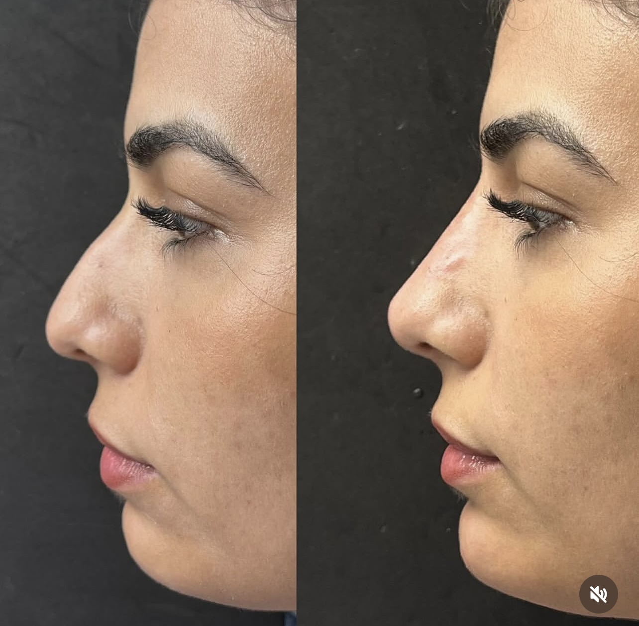 rhinoplasty Patient 13