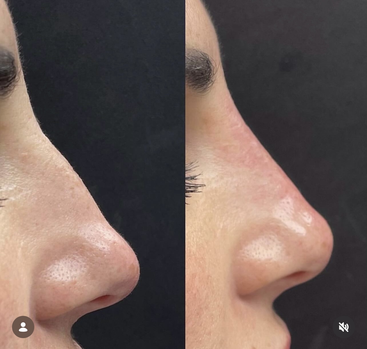 rhinoplasty Patient 12