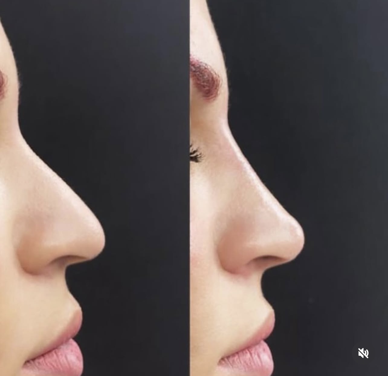 rhinoplasty Patient 11