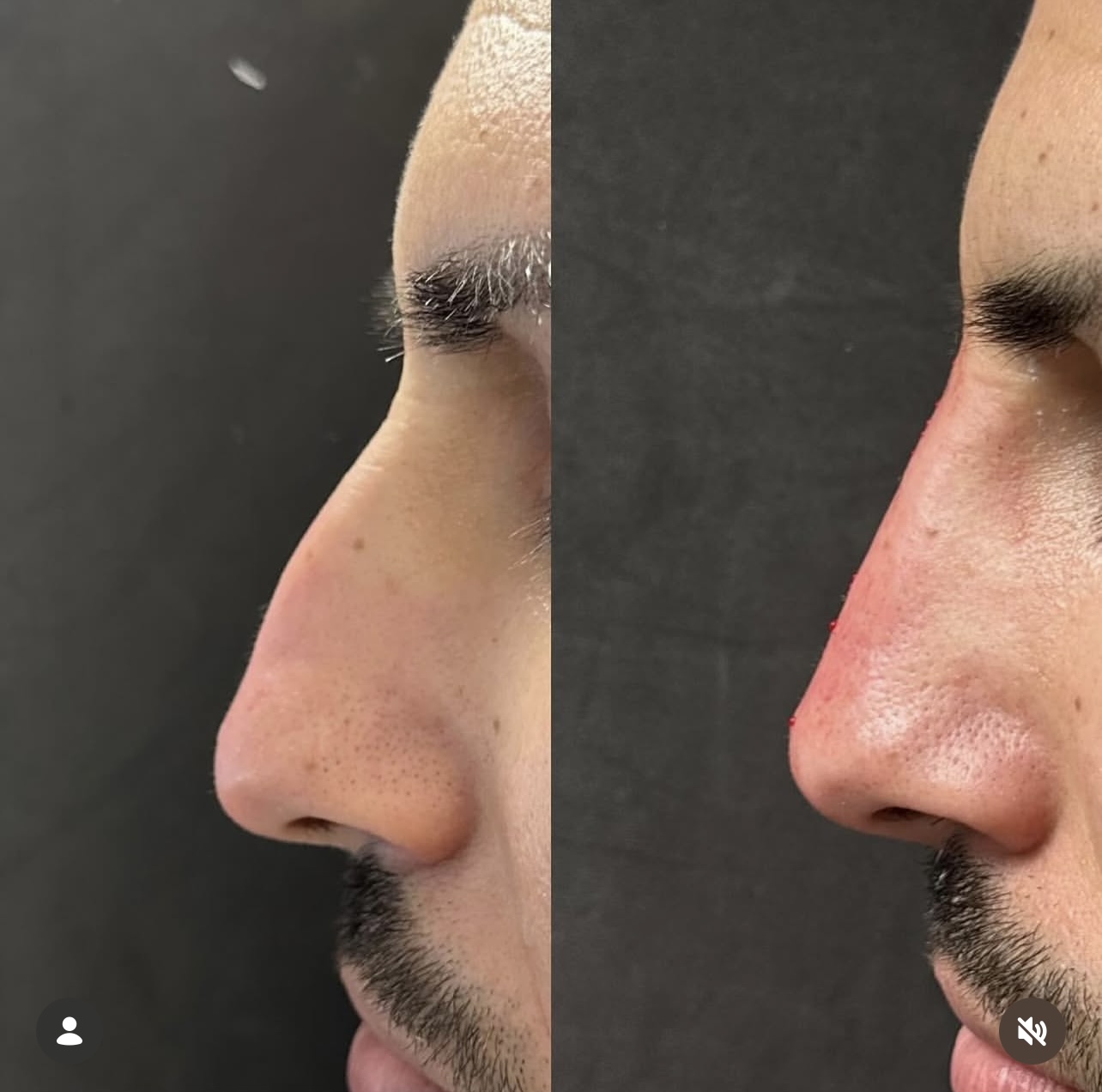 rhinoplasty Patient 9