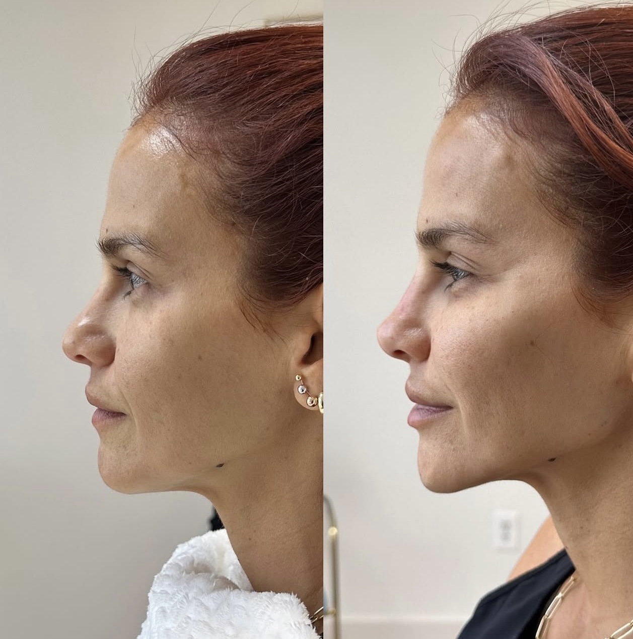 rhinoplasty Patient 8