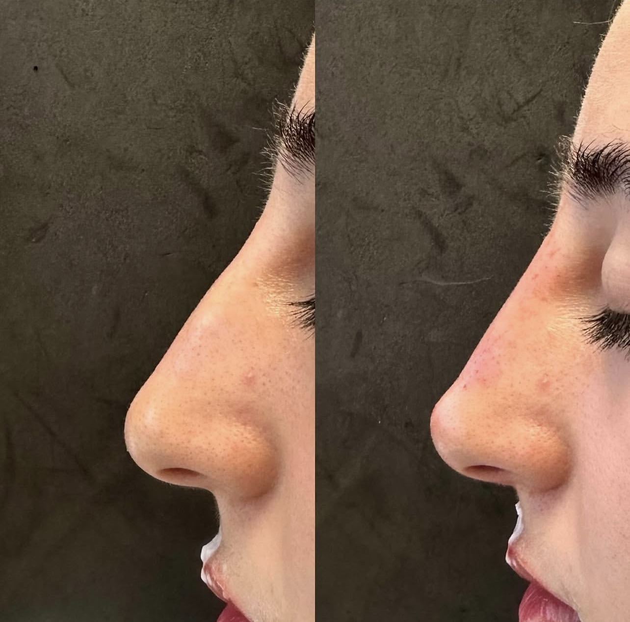 rhinoplasty Patient 7