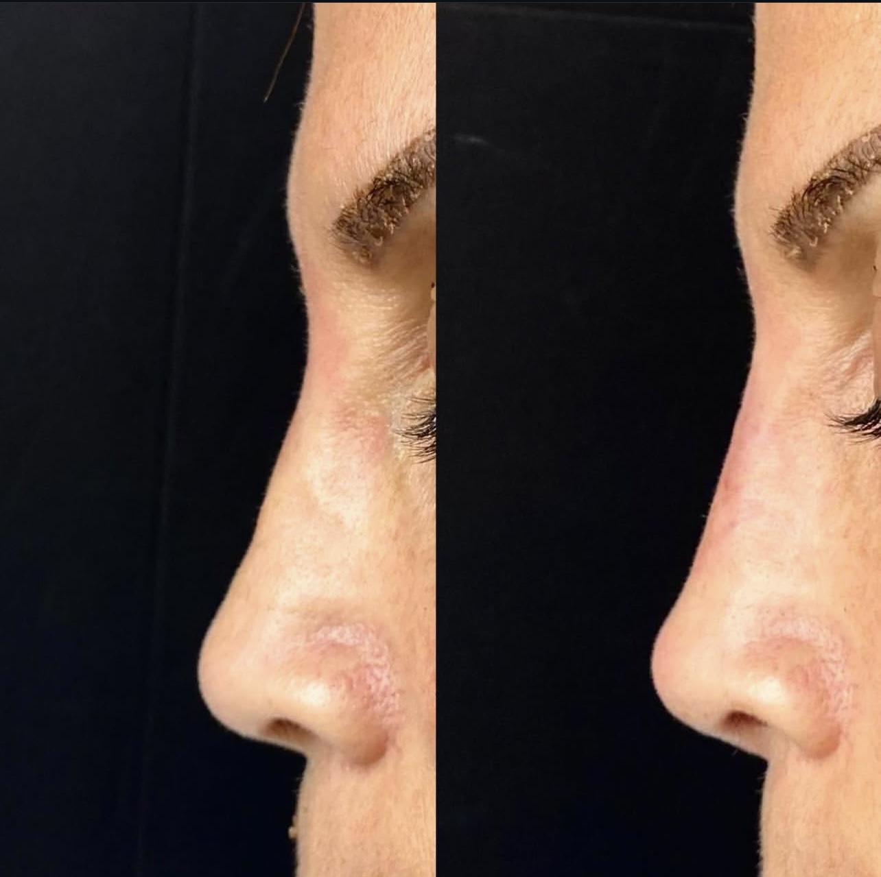 rhinoplasty Patient 6