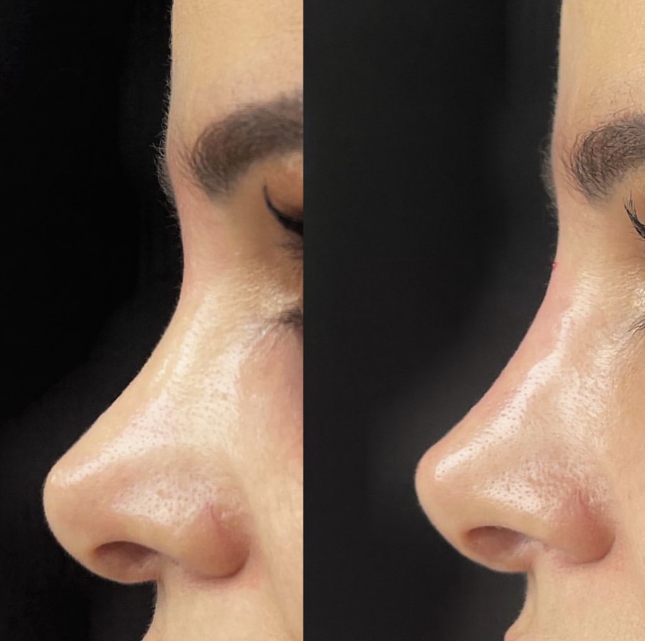 rhinoplasty Patient 5