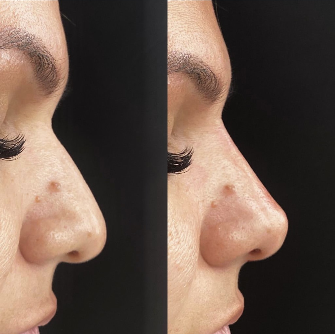 rhinoplasty Patient 4