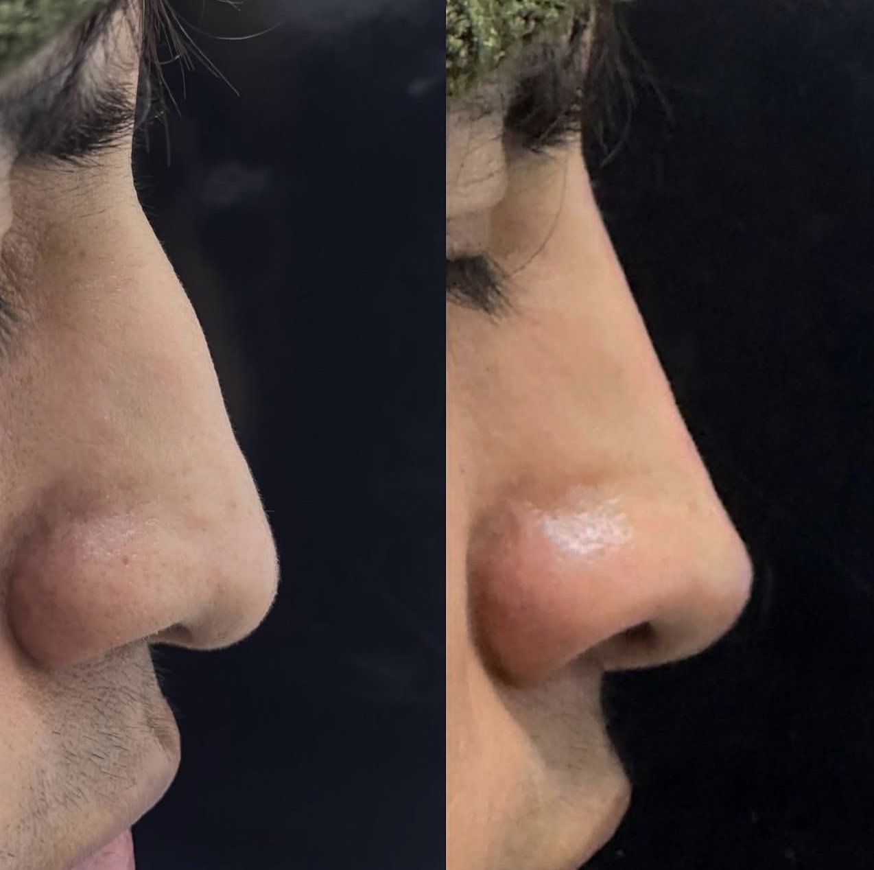 rhinoplasty Patient 3