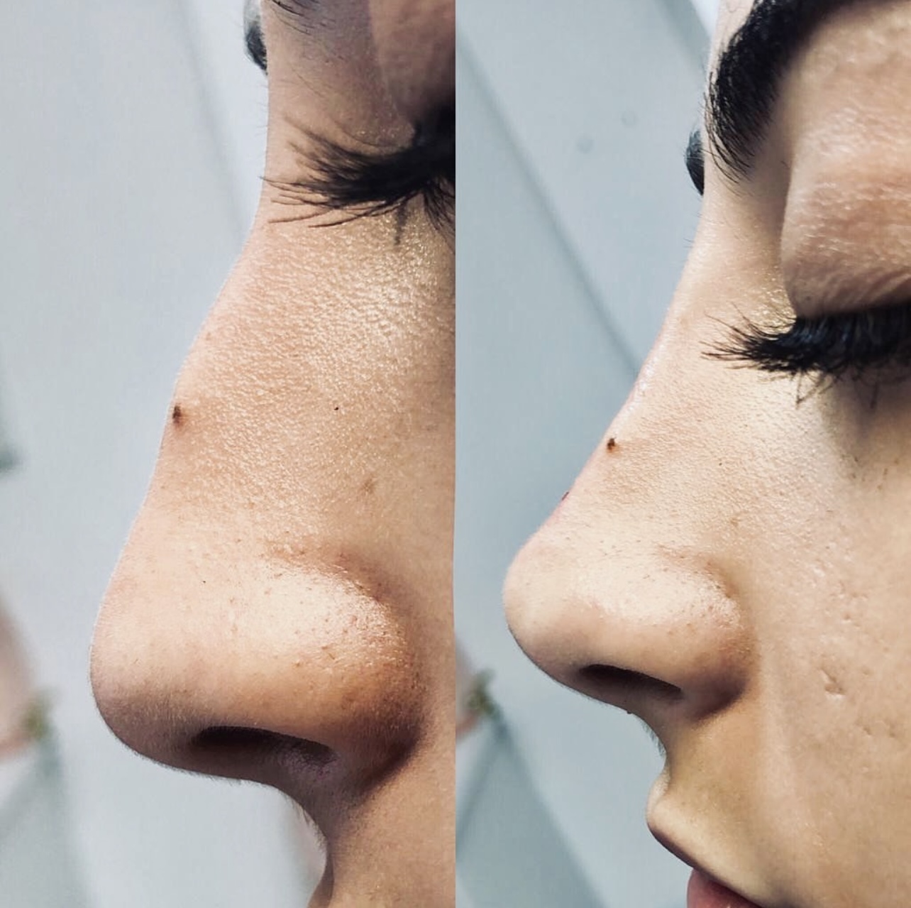 rhinoplasty Patient 1