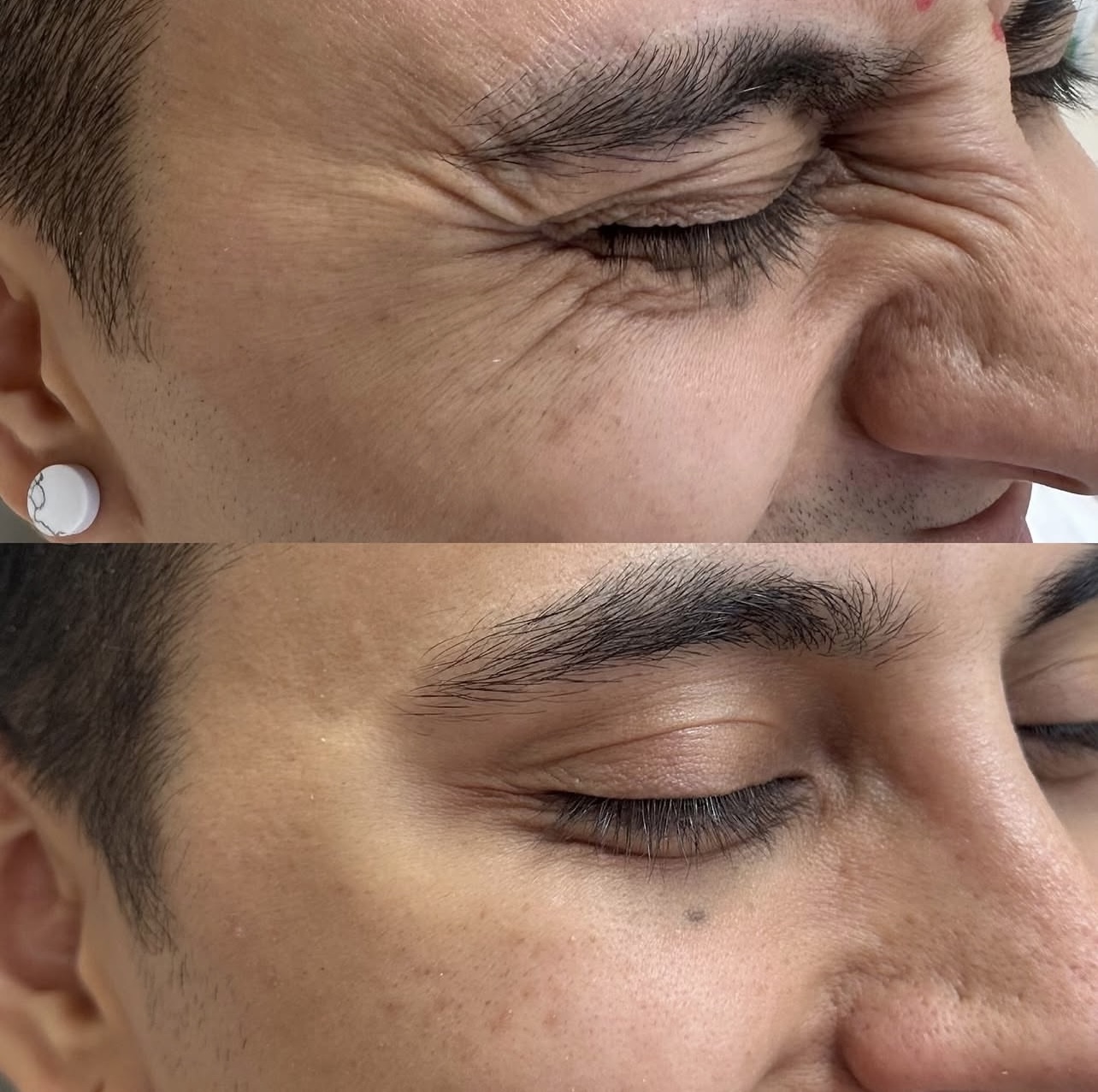 toxina-botulinica Patient 9