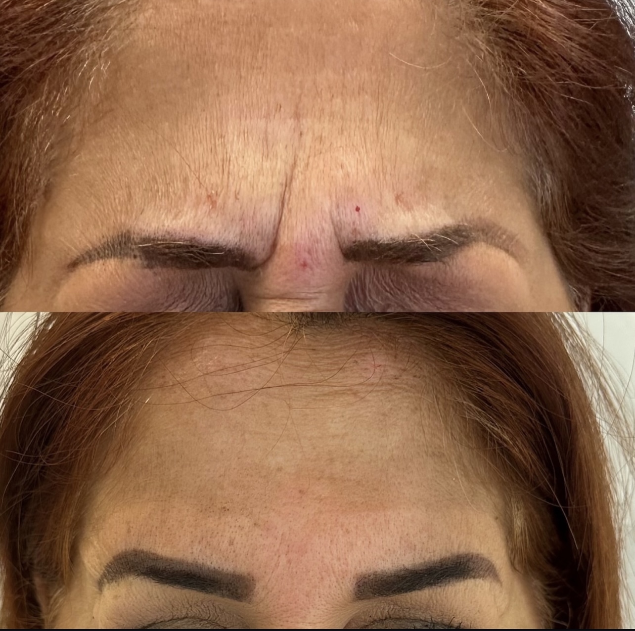 toxina-botulinica Patient 8