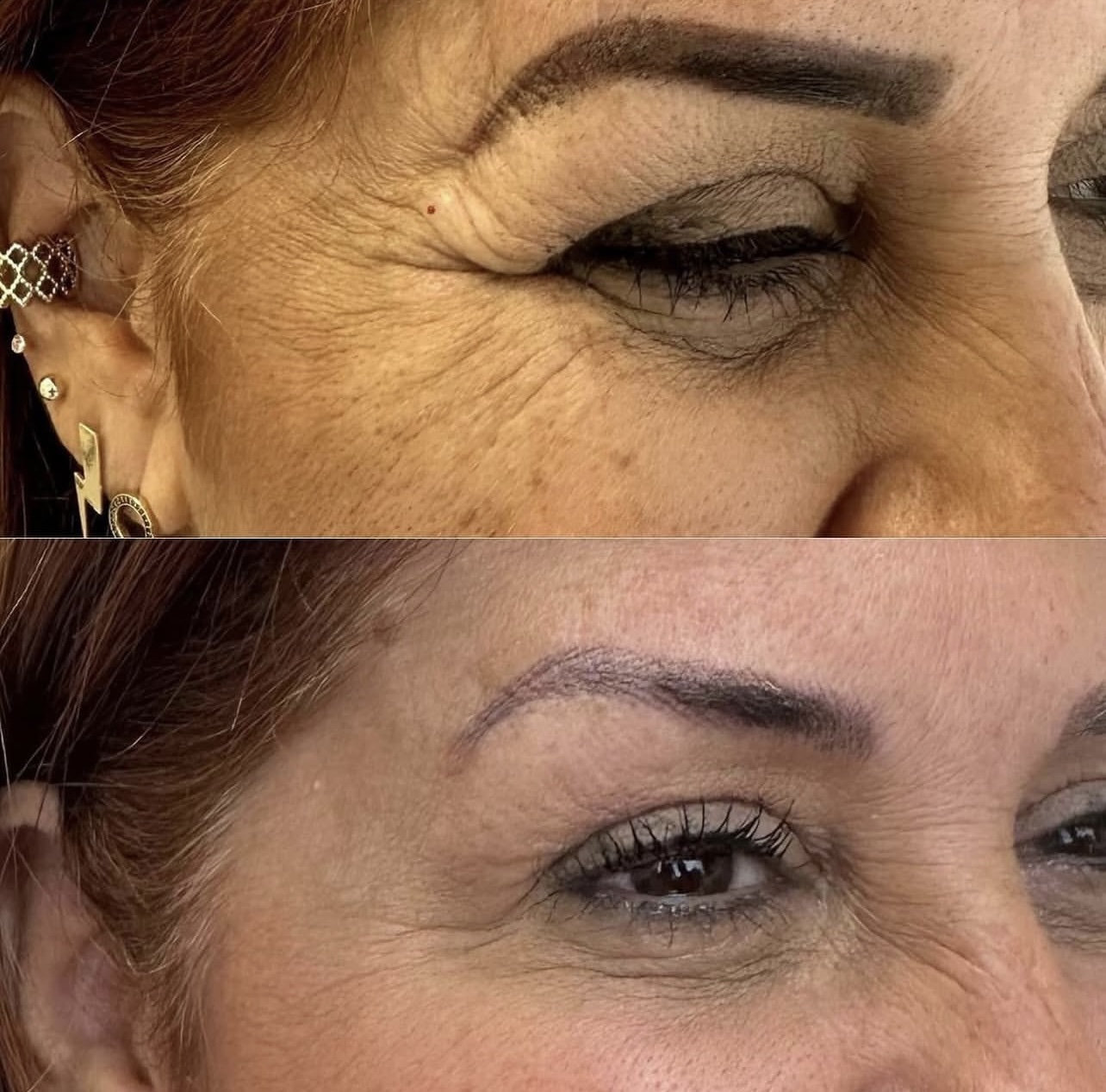 toxina-botulinica Patient 7