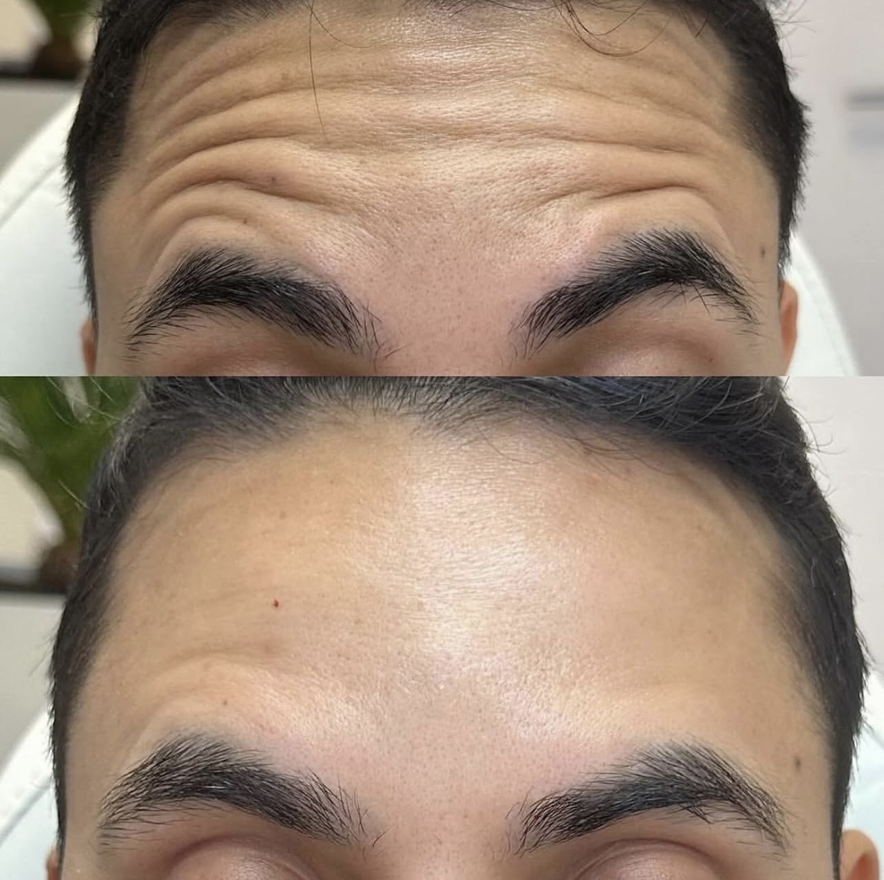 toxina-botulinica Patient 6