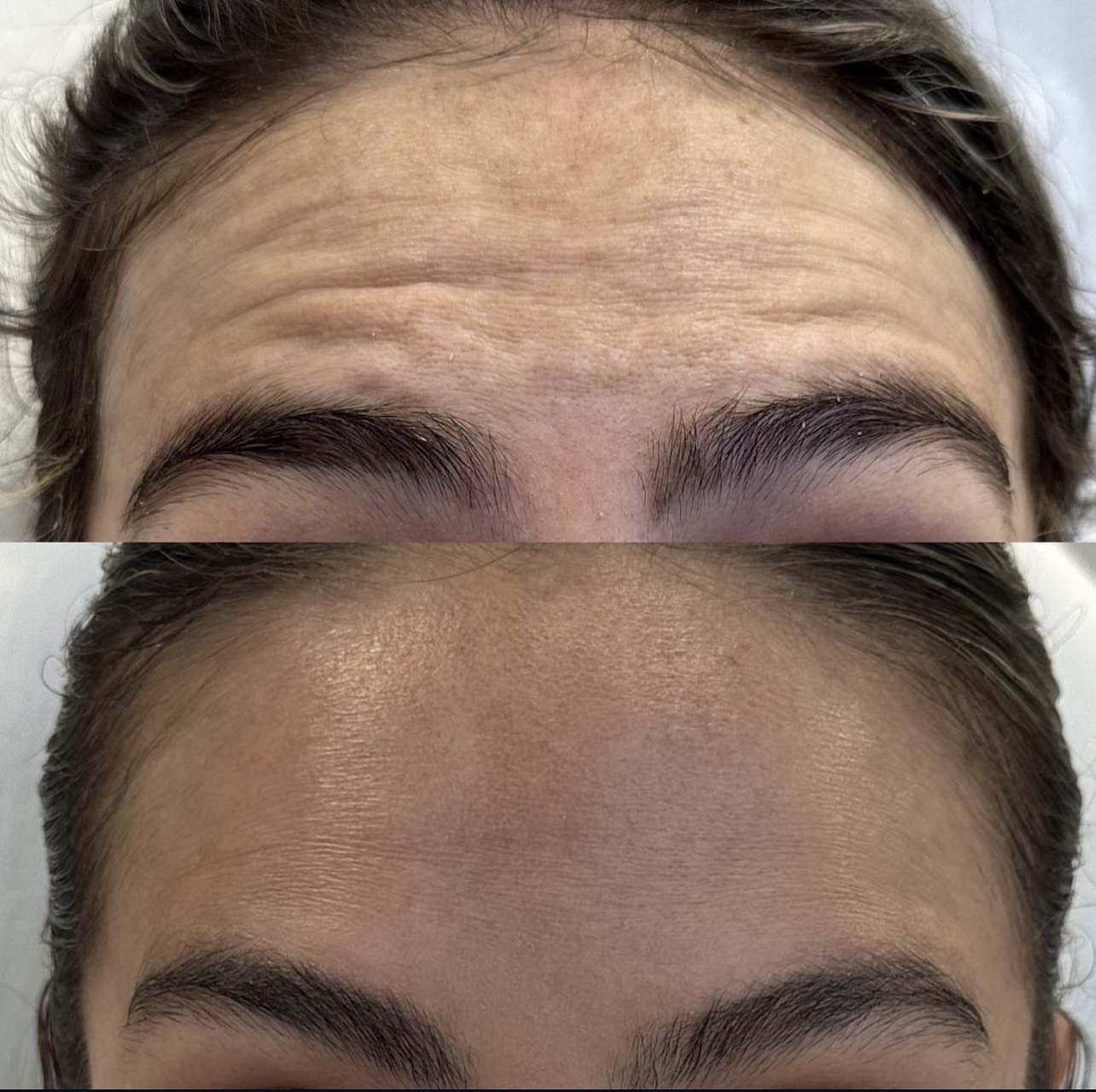 toxina-botulinica Patient 5