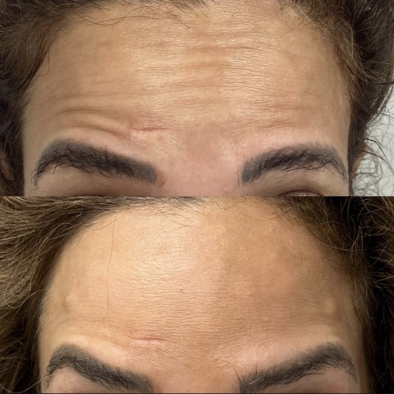 toxina-botulinica Patient 4