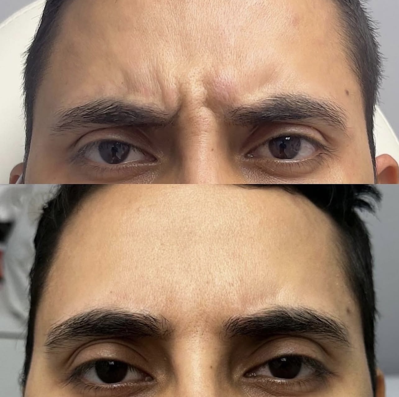 toxina-botulinica Patient 3