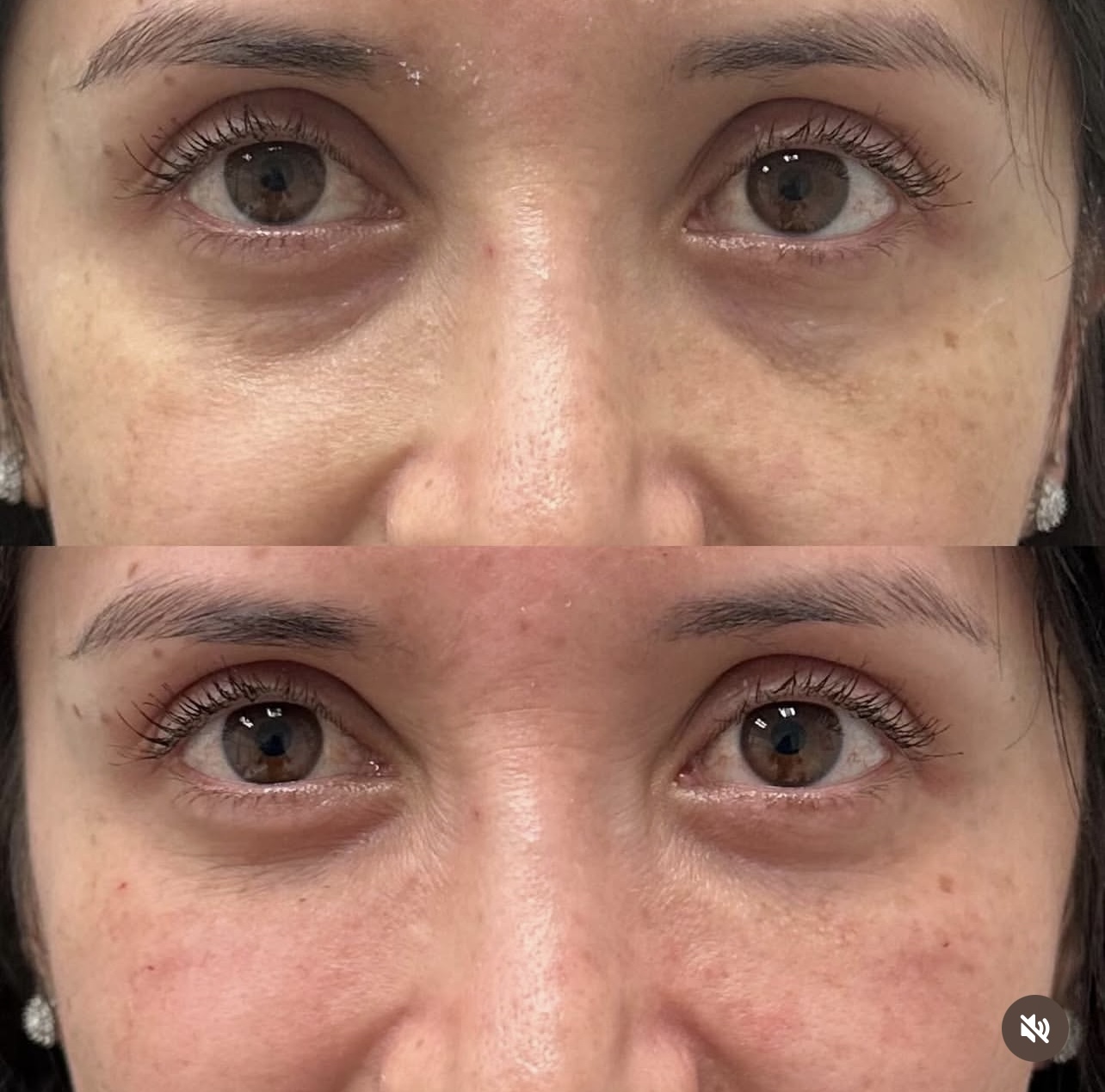 under-eye-correction Patient 10