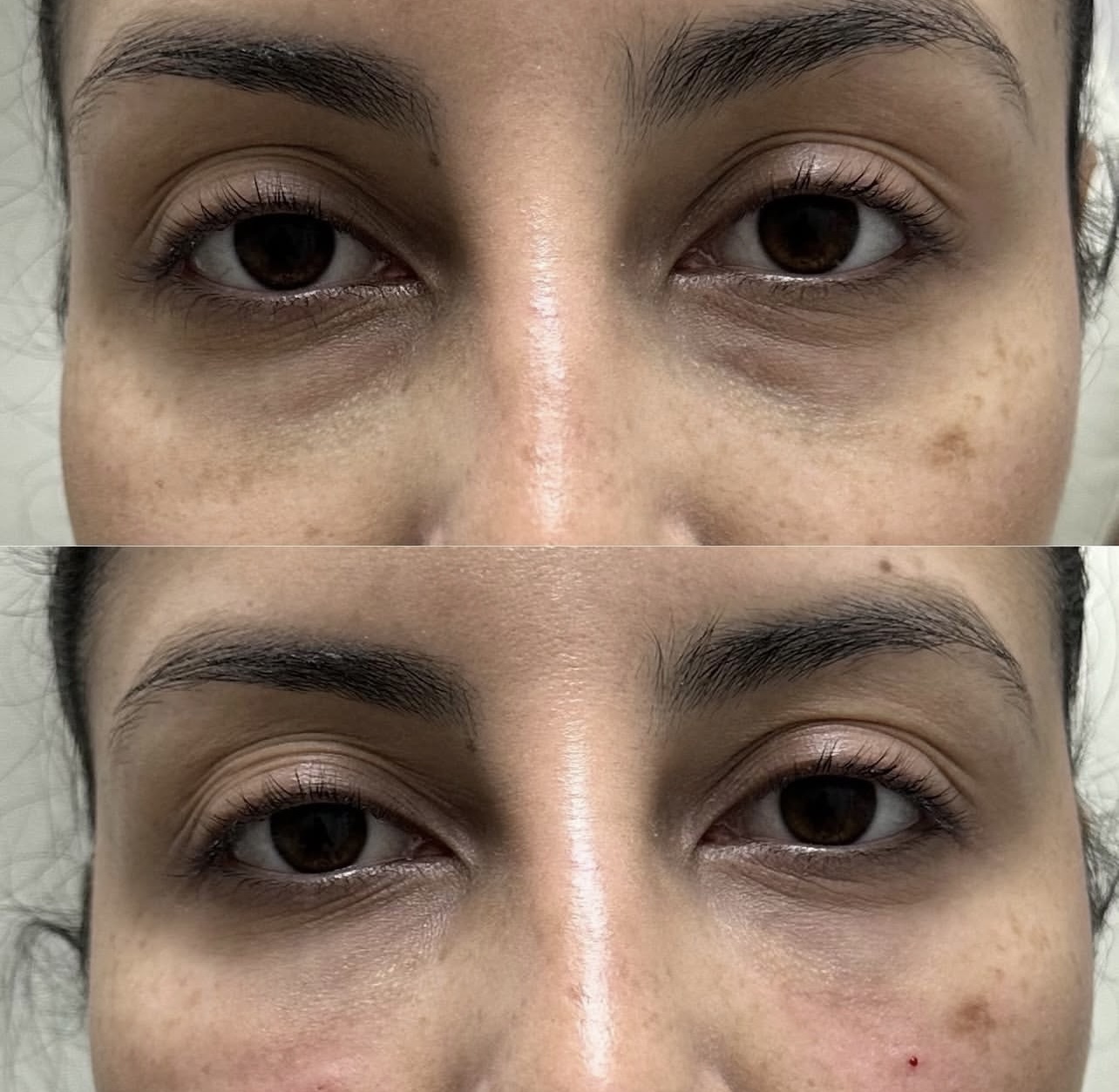 under-eye-correction Patient 8